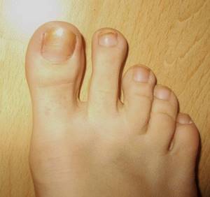Болит ноготь на большом пальце ноги: при нажатии, что делать