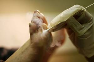 Мозоль между пальцами на ноге болит со стержнем: лечение