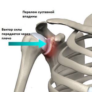 Перелом головки плечевой кости: компрессионный, механизм