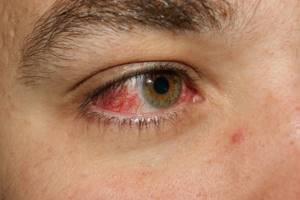 Красные глаза и болят: причины, покраснел один, что делать