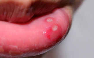 Пузырек на губе: внутри появился водяной пузырь, вскочил