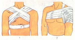 Повязка на плечевой сустав: фиксирующая на плечо