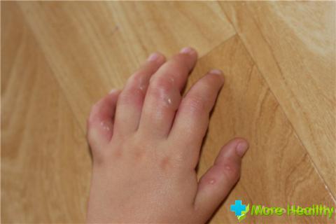 Водянистые пузырьки на пальцах рук: мелкие, лечение, как лечить