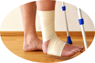 Перелом лодыжки без смещения: когда можно наступать на ногу