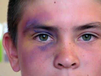 Гематома на лице после удара: лечение, как лечить