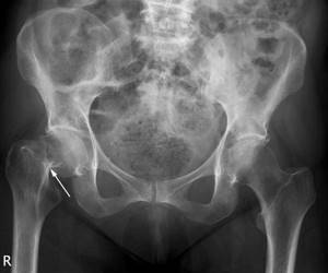 Перелом бедренной кости: в пожилом возрасте, сроки восстановления