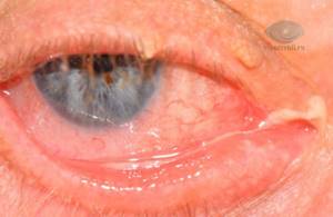 Болит уголок глаза: внешний, при моргании, у переносицы