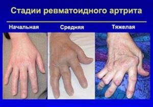 Болит и немеет левая рука от плеча до кисти: ноет, причины