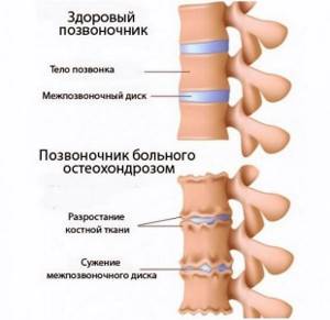 Болит шея с правой стороны: сзади, спереди, плечо, боль
