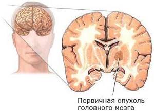 Пульсирующая боль в правой части головы: стороны, в одном месте