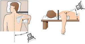 Вывих плечевого сустава: привычный, лечение в домашних условиях