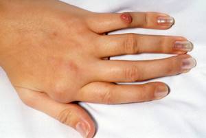 Болит сустав указательного пальца правой руки: боль, артрит