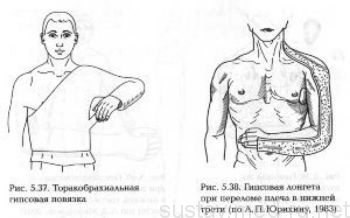 Перелом плечевой кости: иммобилизация, фиксация