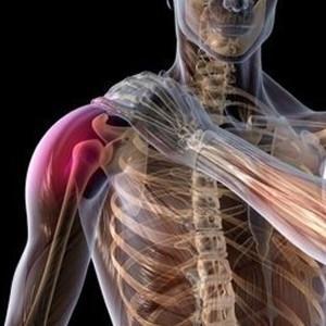 Перелом большого бугорка плечевой кости: без смещения, лечение