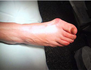 Болит косточка на ноге около большого пальца: что делать, чем лечить