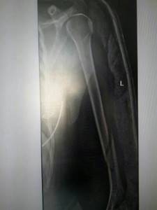 Перелом плечевой кости со смещением: лечение, операция