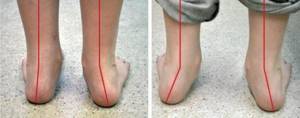 Болят пальцы на ногах: причины, как лечить, что делать