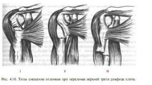 Перелом диафиза плечевой кости: тела, закрытый