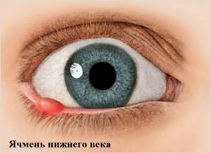 Болит глаз под верхним веком больно нажимать: внутри