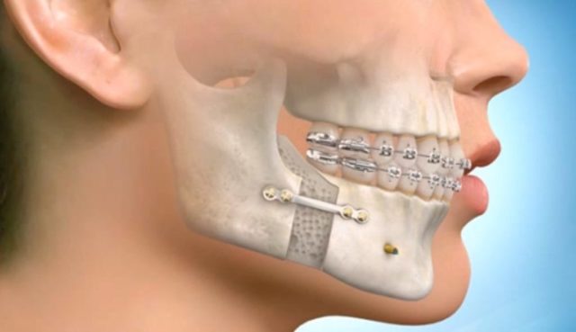 Перелом челюсти: лечение в домашних условиях, как лечить
