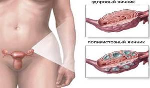Болит левый яичник: причины у женщин, боли слева