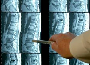 Травма спинного мозга: реабилитация, лечение, восстановление