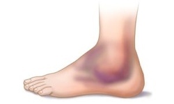 Гематома на ноге после ушиба: лечение, мазь, гель