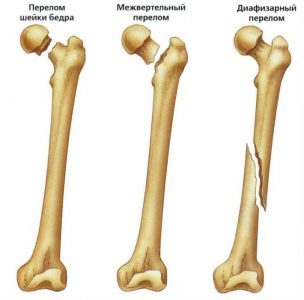 Вертельный перелом бедренной кости: большого, малого, вертела
