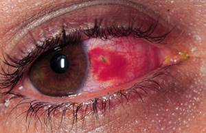 Ожог глаза сваркой: что делать, лечение в домашних условиях
