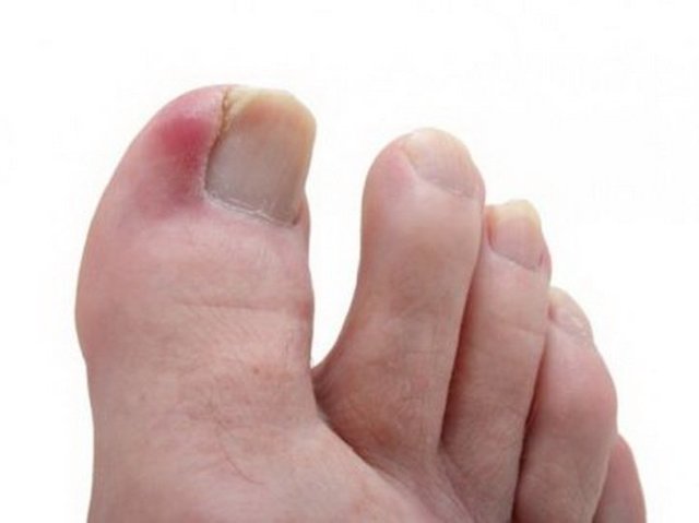 Опух палец на ноге без причины и болит: распух, что делать