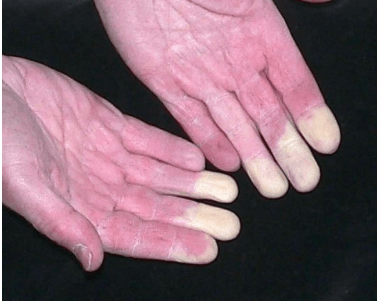 Болит средний палец на правой руке: сустав, косточка