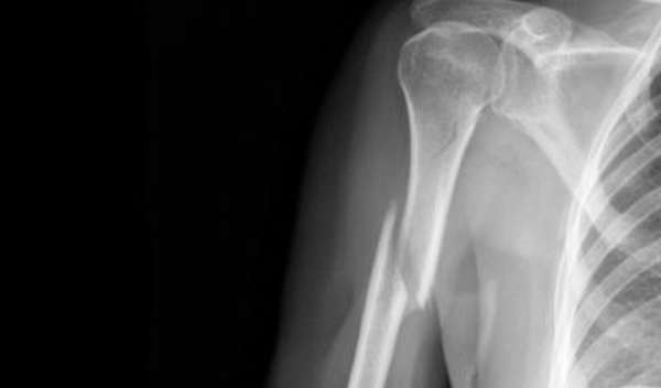 Перелом проксимального отдела плечевой кости: конца