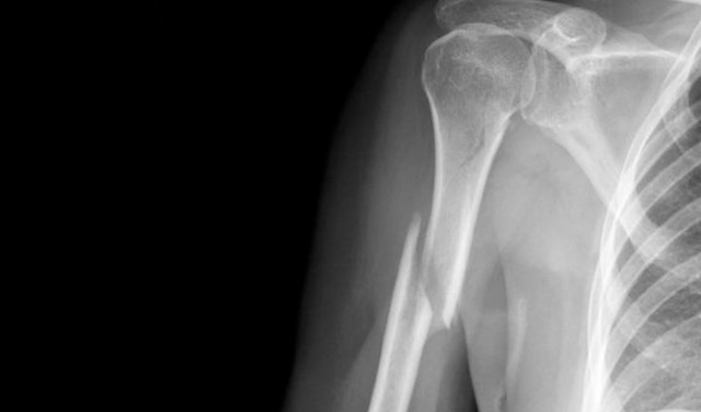 Перелом диафиза плечевой кости: тела, закрытый