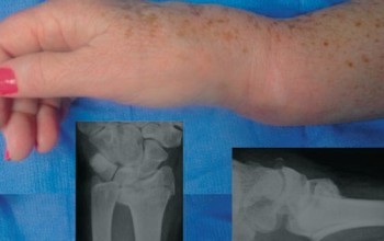 Перелом шиловидного отростка лучевой кости: без смещения