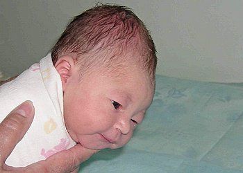 Гематома на голове: после ушиба, у новорожденных, лечение