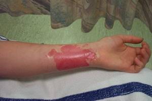 Химический ожог кожи: лечение в домашних условиях, первая помощь