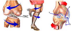 Повреждение связок коленного сустава: сроки восстановления