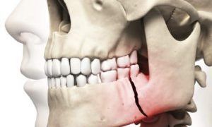 Перелом челюсти: последствия, со смещением, открытый