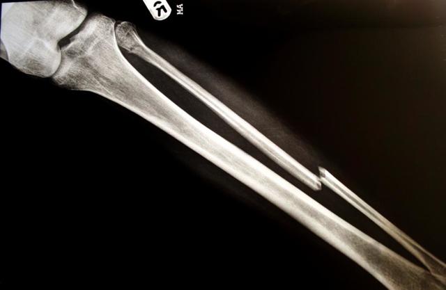 Перелом большой берцовой кости без смещения: сколько ходить в гипсе