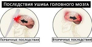 Ушиб головного мозга: симптомы и лечение, последствия