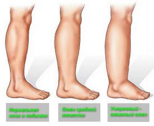 Болят ноги от колена до ступни: боли до стопы, причины, лечение