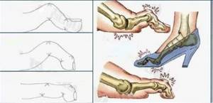 Боль в пальцах ног при ходьбе: причины, лечение, почему болят