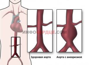 Разрыв сердца: причины, сущность повреждения аорты, желудочка