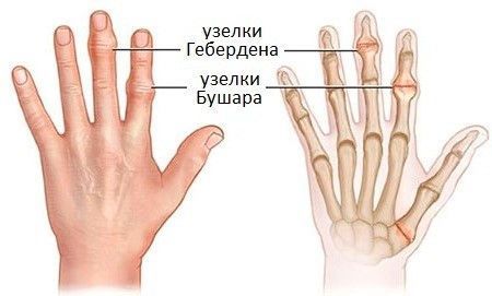 Немеет средний палец на левой руке: причины, от чего