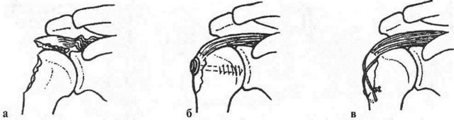 Вколоченный перелом плечевой кости: головки, хирургический шейки