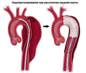 Разрыв сердца: причины, сущность повреждения аорты, желудочка