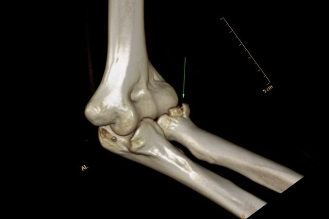 Перелом головки лучевой кости локтя: лечение и восстановление