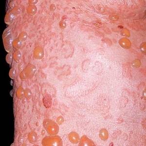 Водянистые пузырьки на коже: скопление, лечение