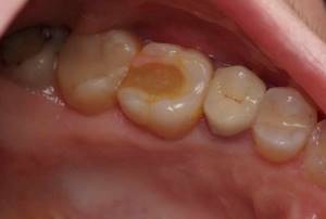 После пломбирования болит зуб: при надавливании, больно нажимать