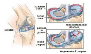 Хруст в колене и боль: болят при сгибании, сильная
